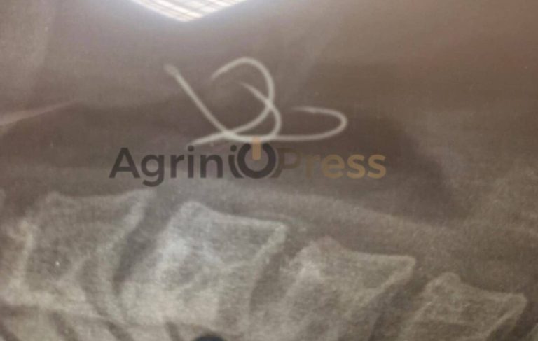 «Έγινα μπλε»: Τι λέει ο 38χρονος που κατάπιε αγκίστρια – Δεν τον αναλάμβανε κανένα νοσοκομείο για 5 ώρες
